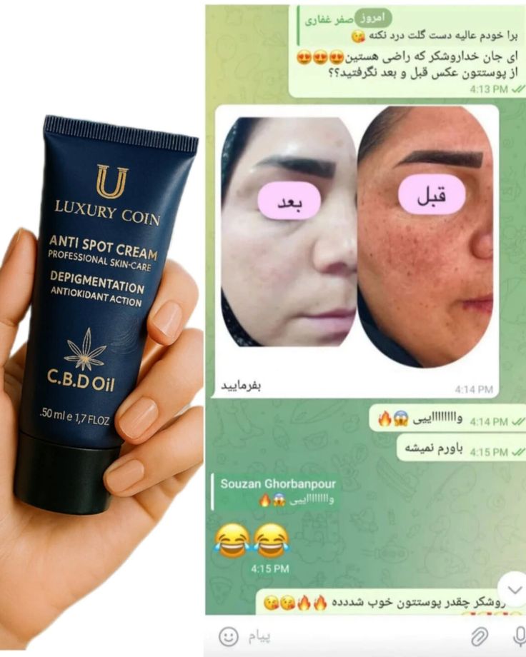کرم ضد لک  لاکچری کوین.حتی تو خوابتم تمام لکات درمان میشه‼️😱 مطمئنم تا حالا همچین محصول استثنایی ندیدی 😍👇 💎کرم ضدلک ۸ کاره فرانسوی: ✅ضدلک و روشن کننده  ✅ حاوی ضدآفتاب  آبرسان و مرطوب کننده  ضد حساسیت  ضدجوش و کاهنده منافذ ضدچروک و جوانساز همه اینها باهم فقط تو یه محصول میتونی داشته باشی دیگه چی میخوای از این بهتر؟؟